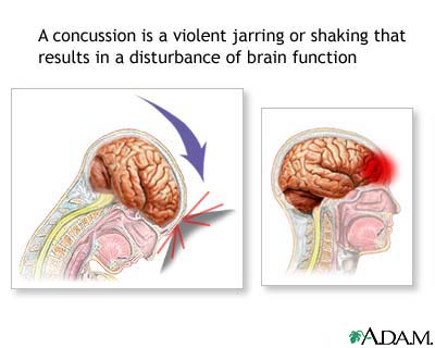 An illustration of a concussion, a violent jarring or shaking that results in a disturbance in brain function